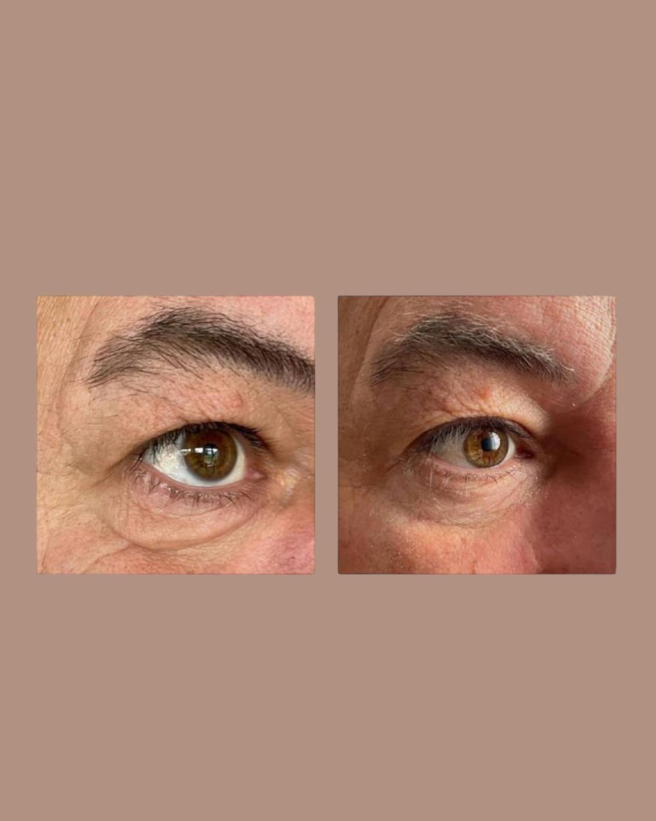 Peptilux Augencreme gegen Tränensäcke/Falten/Augenringe 20ml (LUX001)